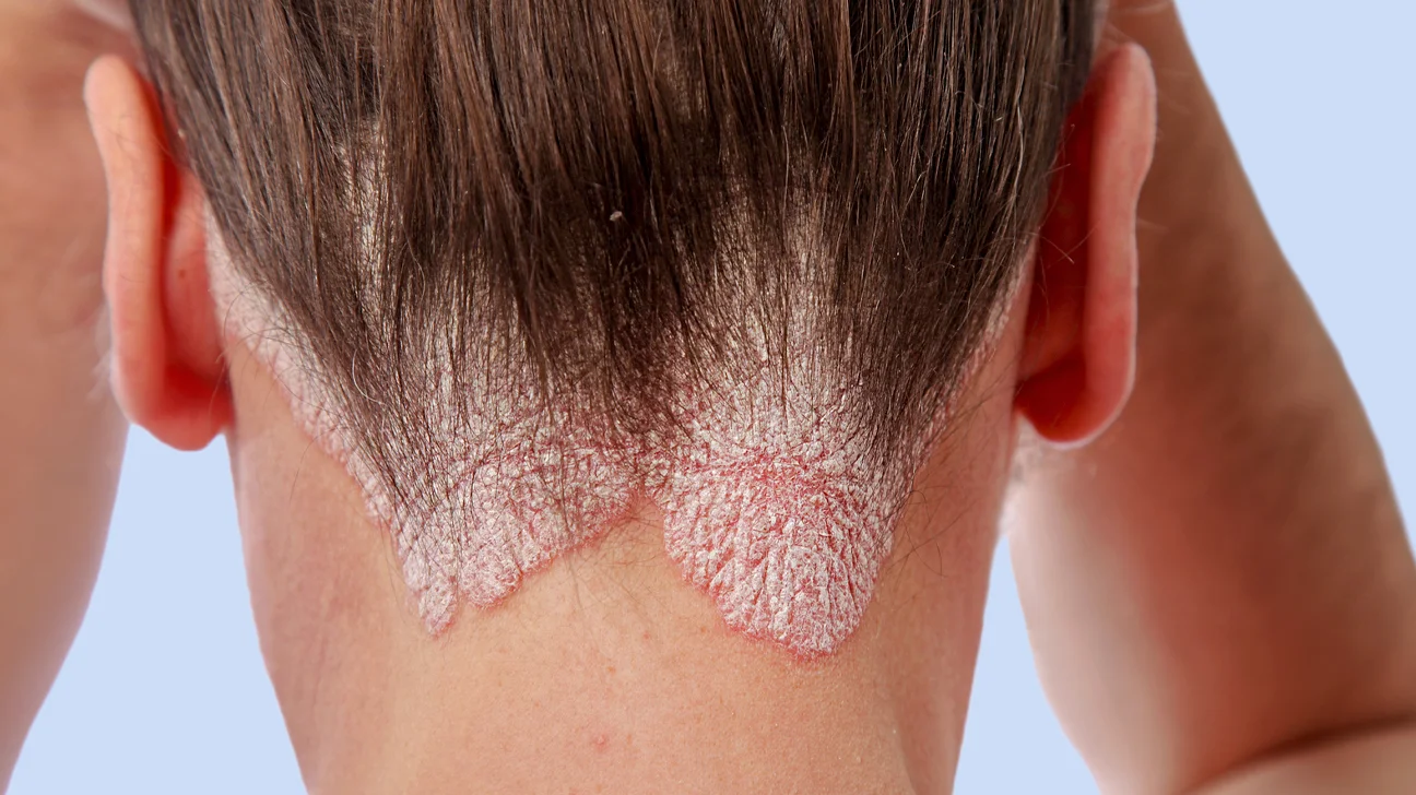 Skin disease