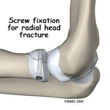 elbow radial head fracture