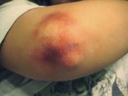 bruised elbow