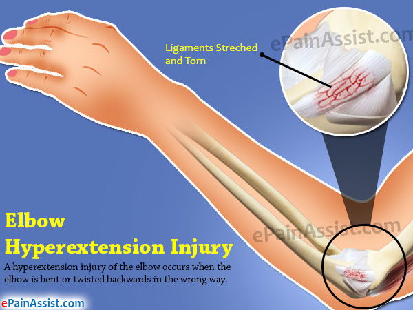 elbow hyperextension