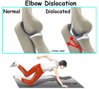 dislocated elbow