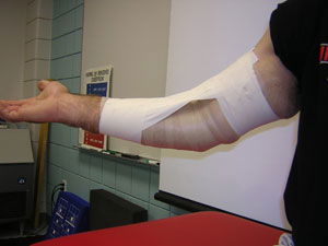 Elbow Hyperextension