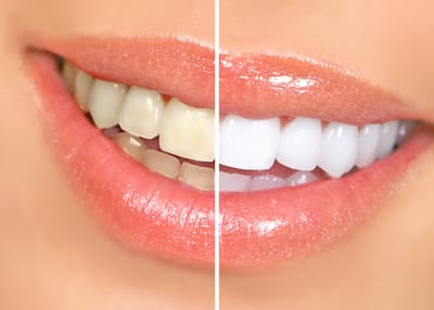 Teeth whitening gel