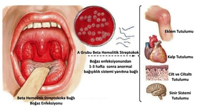 STREP-A HASTALIĞI